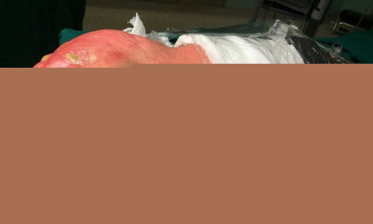 Bóc tách thành công khối u quái khổng lồ ở trẻ sơ sinh