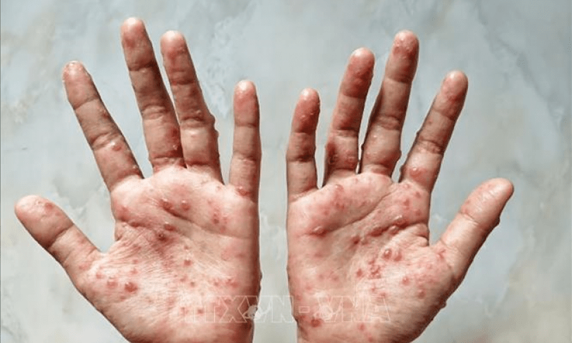 6 giải pháp phòng, chống dịch bệnh đậu mùa khỉ