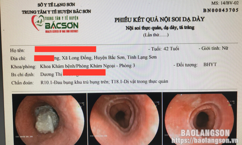 Trung tâm y tế huyện Bắc Sơn cấp cứu thành công bệnh nhân bị hóc thức ăn