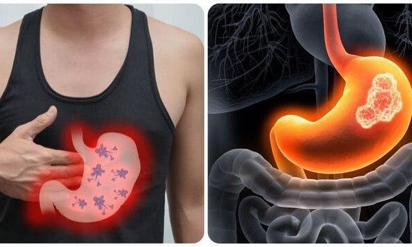 6 triệu chứng ung thư dạ dày giai đoạn đầu