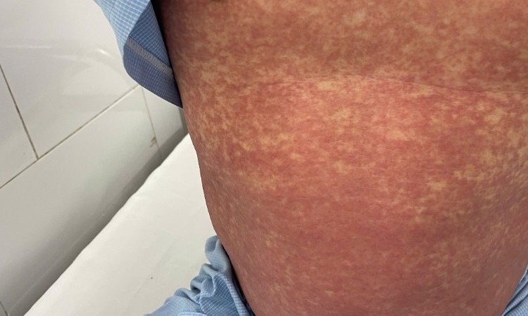 Bộ Y tế: Người dân tuyệt đối không mua, bán hoặc sử dụng các thuốc chứa Phenylbutazone